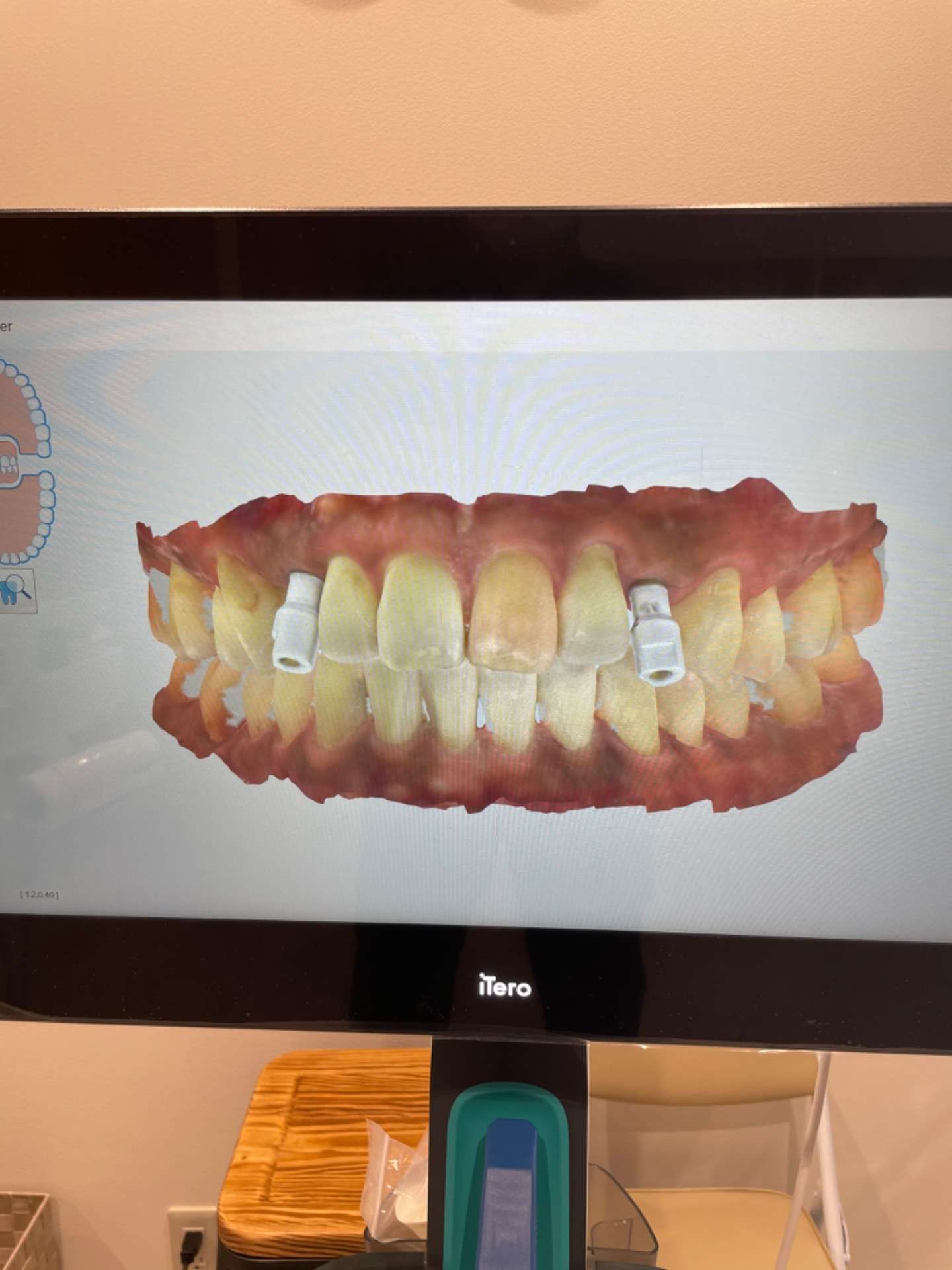 うえさか歯科ではインプラントの上部構造も口腔内スキャナーが使えます！